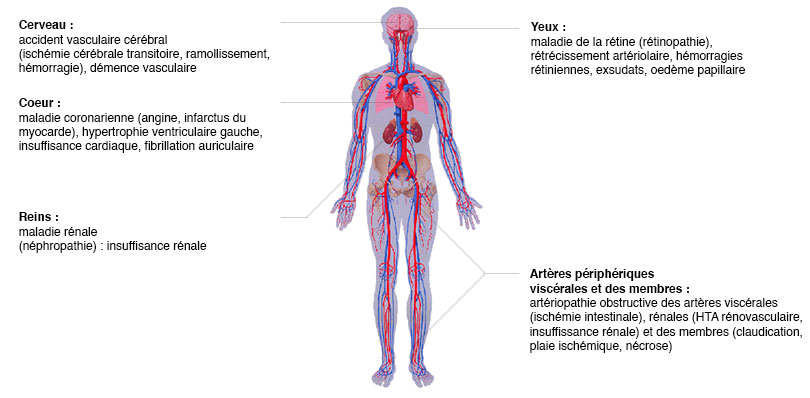 Exemples d’atteinte d’organes cibles en présence d’hypertension artérielle