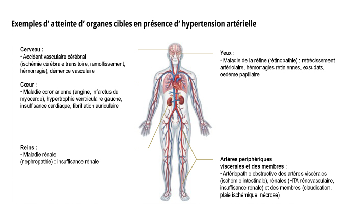 Exemples d'atteintes d'organes cibles en présence d'hypertension artérielle